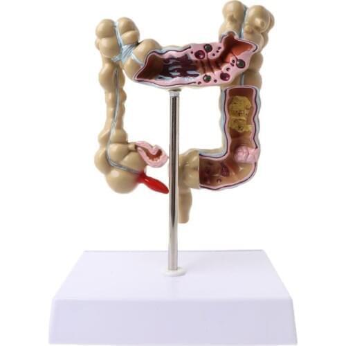 Human Colorectal Lesion Model Pathological Anatomy Colon Diseases Intestine Medical Teaching Learning Tool