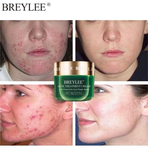 BREYLEE Tea Tree Acne Treatment Face Cream Anti Acne Remove Pimple Spot Oil Control Shrink Pore Moisturizing Whitening Skin Care