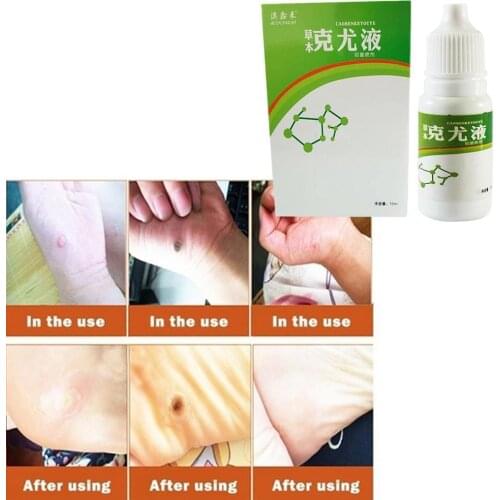 Genital Warts Treatment Papillomas Removal Warts Fluid Remedy From 10Ml Tags Anti Skin Removal Moles Wart Remover Against Q3T3