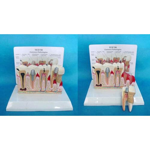 Sick tooth model worm tooth decay tooth disease dental rash teaching aid beauty tooth tooth cavity repair gum inflammation