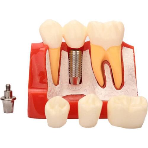 1pc Resin Dental Demonstration Tooth Model Implant Analysis Crown Bridge for Dentist