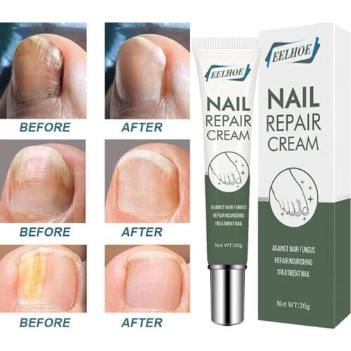 20ml Nail Antibacterial Cream Fungal Nail Treatment Serum Nail Foot Nail Fungus Removal Gel Onychomycosis Nail Repair Cream