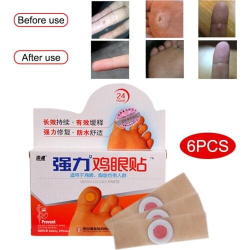 6 Pcs Medical Calluses Plantar Warts Thorn Plaster Removal Pain Relief Patch Feet Corn Removal SSwell