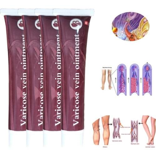 10Pcs/Lot Varicose Veins Treatment Cream Effective Cure Vasculitis Phlebitis Spider Veins Pain Varicosity Angiitis Ointment