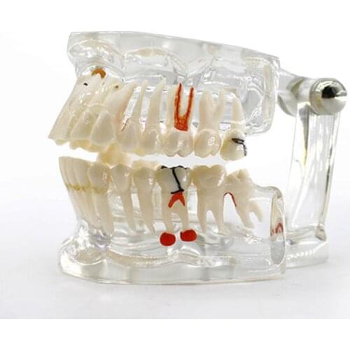 Implant Dental Teeth Model With Restoration Bridge Tooth Dentist For Denture Science Teaching Study Tool