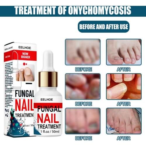 10/50ml professional Foot Anti-fungal Repair Solution Anti Fungus Toenail Growth Remove Onychomycosis Care Repair Liquid