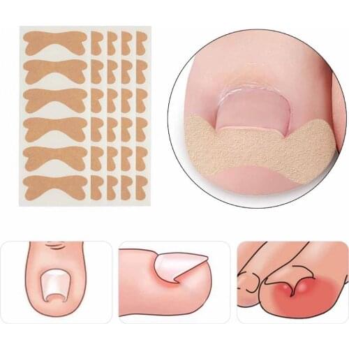 24Pcs/30Pcs/36Pcs/48Pcs/60Pcs Butterfly Shape Toenail Ingrown Patch Drop-Down Ultra Thin Nail Correcting Ingrown Patch for Unise