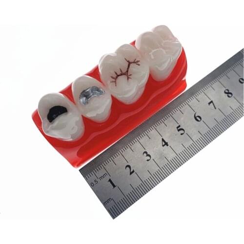 Dental Study Learn Model for Pit and Fissure Sealing Treatment Teeth Model