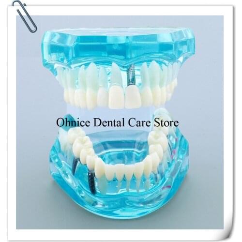 Dental Implant Restoration teeth Model M2001 Dental teaching tooth model/Dental Lab Clinic teeth model