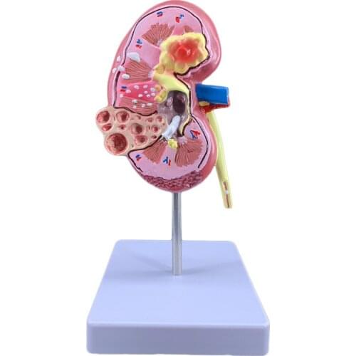 Human kidney anatomical model lesion kidney anatomical model lesion internal organs teaching model