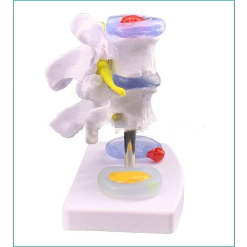 Intervertebral disc herniation model bone pathology model model medicine teaching for lumbar spine bone medicine teaching