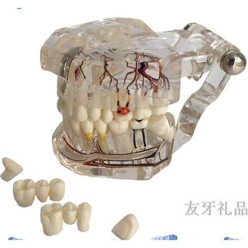 Transparent pathological implant nerve tooth model repair model oral teaching demonstration model