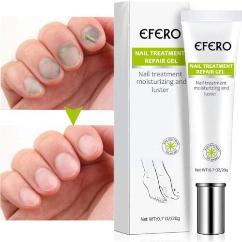 Herbal Fungal Nail Treatment Essence Nail Foot Toe Anti Paronychia Repair Onychomycosis Removal Gel Nail Infection Foot Fun K3Q6