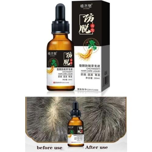 30ml hair growth essence for men and women,to prevent hair loss,prevent baldness, repair damaged hair, fast-growing hair essence