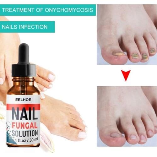 10/20/30ML Foot Anti-fungal Serum To Remove Onychomycosis Care Repair Liquid Healthy Nail Care Nail Treat