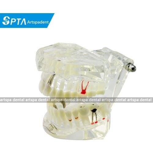 Dental Implant Disease Teeth Can Remove Model Restoration & Bridge Tooth Ideal Medical