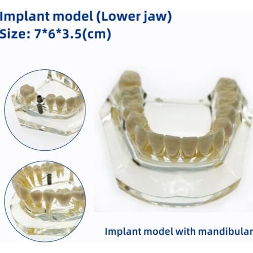 Dental Upper/Lower Implant model with bridge and caries implant Mandibular Teeth