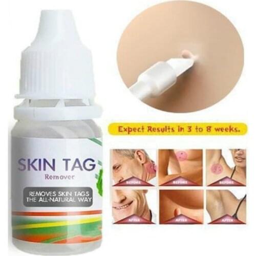 Skin Tag Remover 12 Hours Tu Kill Medical Tu Kill Remover Skin Tag Mole Genital Wart Remover Foot Corn Blackhead Remover