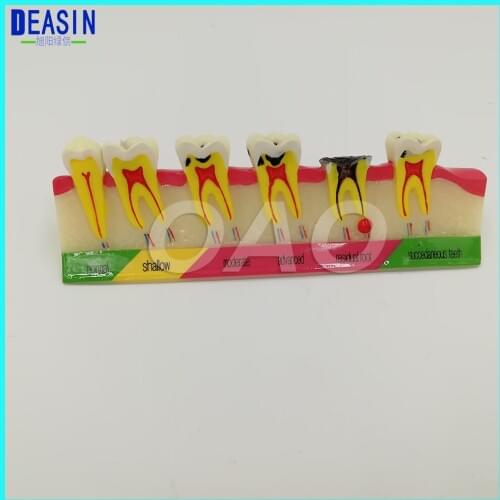 Free shipping Dental Caries Developing illusteation Tooth Model Demonstration Teach Patient