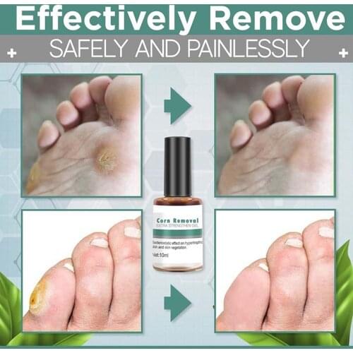 Non-toxic Harmless 10ml Foot Care Corn Removal Pads Warts Thorn Curative Remove Corns Smooth Skin Warts Remover Skin Tag Remover