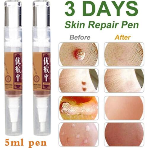 New Genital Wart Treatment Papillomas Removal of Warts Liquid From Skin Tags Removing Against Moles Remover Wart Removal liuld