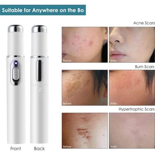 Blue Light Therapy Varicose Veins Treatment Laser Pen Soft Scar Wrinkle Removal Treatment Acne Laser Pen Massage Relax