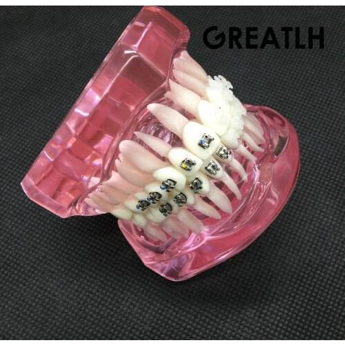 Dental Orthodontic Model with Metal and Ceramic Brackets 3003 Pink Dental Teeth Study Model
