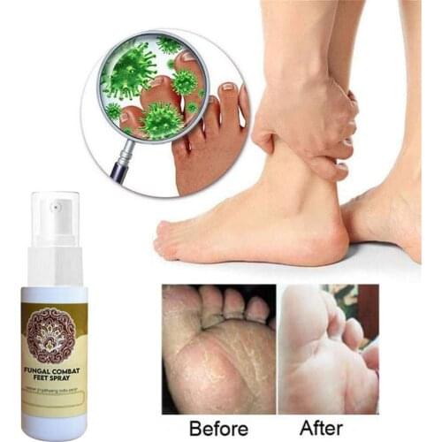Natural Herbal Antifungal Foot Care Tools Foot Spray Antibacterial Antipruritic Sweat Smell Spray Antifungal Foot Deodorant