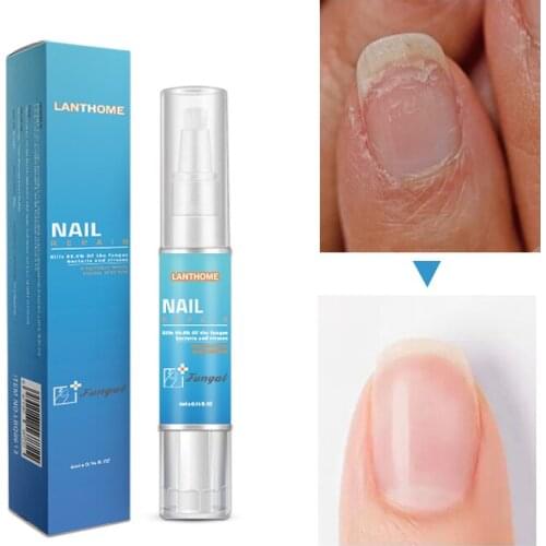 Lanthome Nail Fungus Oils