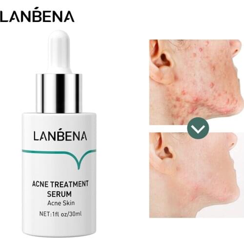 LANBENA Acne Remove Serum Deep Cleansing Pore Anti-inflammatory Refreshing Essence Shrinking Pore Gentle Oil Control Skin Care