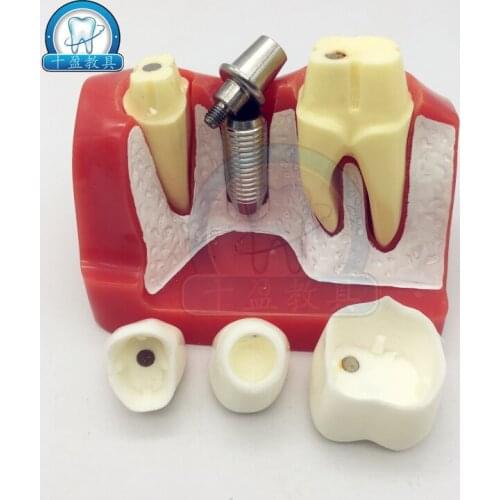 Dental teaching model 4X tooth planting explanation model implant nails