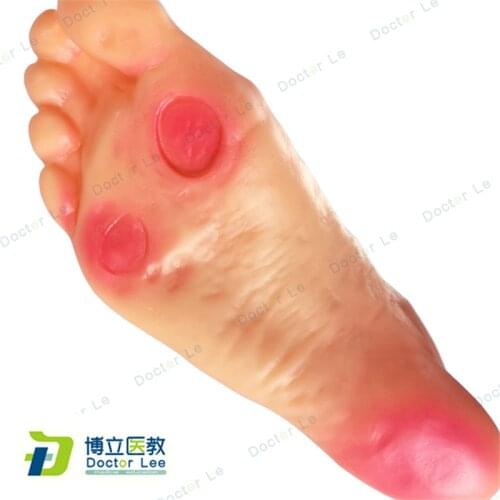 Diabetic ulcer foot anatomy model for medical supplies and equipment