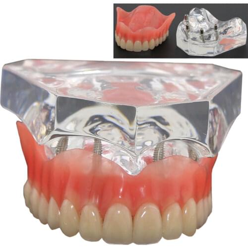 1pcs /pack Dental Upper Overdenture Superior 4 Implants Demo Model 6001 02 Teeth Model