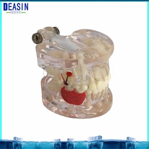 Dental Implant Teeth Dental Pathological Teeth Implant Model Teaching Teeth Model & Restoration Bridge Tooth