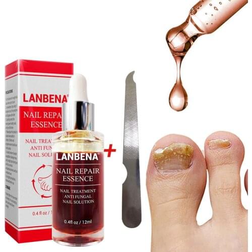 Fungal Nail Treatment Feet Care Essence Nail Foot Toe Nail Fungus Removal Gel Anti Infection Paronychia Onychomycosis