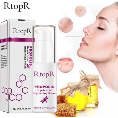 Propolis Anti-Acne Brightening Serum VE Acne Scar Spots Removal Essence Shrink Pores Eliminates Acne-Treatment Oil-Control 20ml