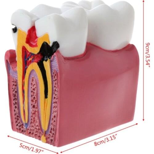 6 Times Dental Caries Comparation Anatomy Teeth Model for Dental Anatomy Lab Teaching Studying Researching Tool for denture