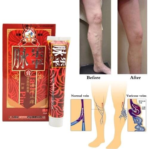 100% Original Veins Varicose Treatment Plaster Treatment Leg Acid Bilges Itching Earthworm Lumps Old Bad Leg Vasculitis Care