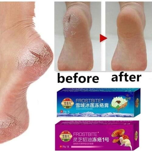 Dead Skin Remover Snowland Ice Ganoderma Frostbite Cream Moisturizing Anti-crack Repair Dry Anti-freeze Cream Skin Care