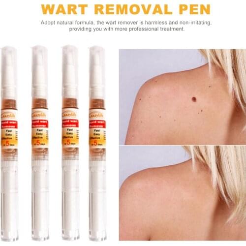 Wart Remover Skin Tag Remover Pen Genital Wart Treatment Papillomas Removal Against Moles Remover Anti Verruca Remedy