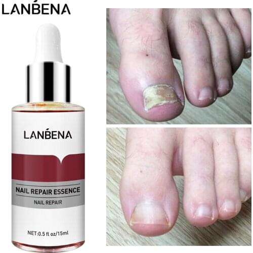 LANBENA Nail Repair Essence Serum Anti Fungal Nail Treatment Remove Onychomycosis Nourishing Brighten Hand Foot Toes Nail Care
