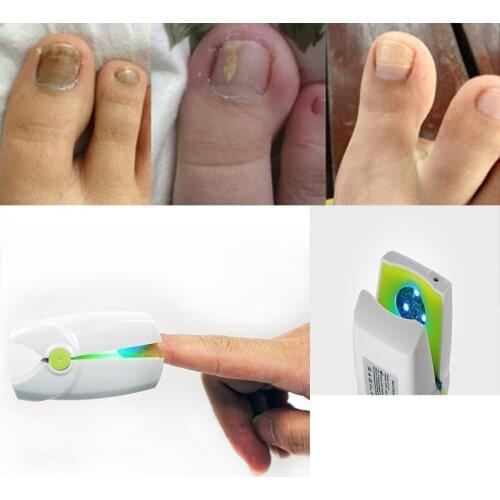 Toenail Fungus Removal light Therapy Device Onychomycosis Paronychia Anti Nail Fungal Infection Nail Repair
