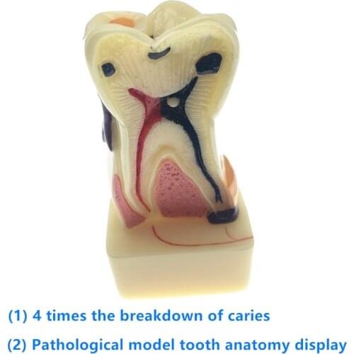 Dentist Dental Study Teach Tooth Model Teeth Disease Model New Dental Supplies