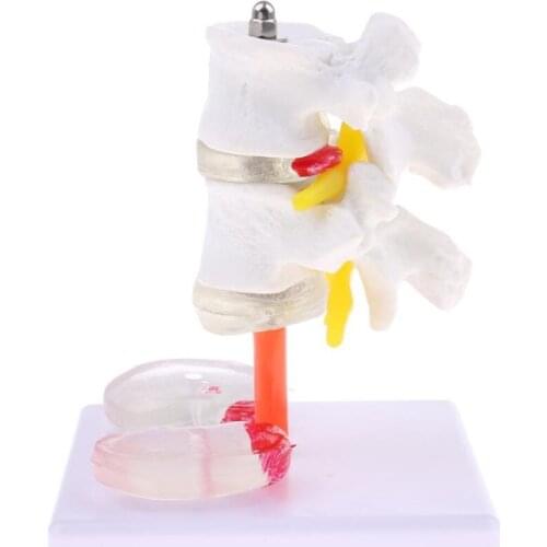 Human 2 Lumbar Vertebra with Diseased Intervertebral Disc Model Medical Skeleton