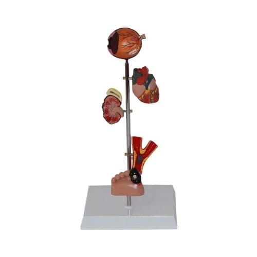 Diabetes target organ foot heart kidney model free shipping