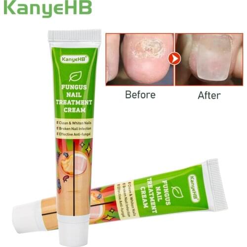 1pcs Removal Paronychia Onychomycosis Nail Fungus Treatment Cream Nail Anti Infection Feet Toe Fungal Nail Care Ointment G004