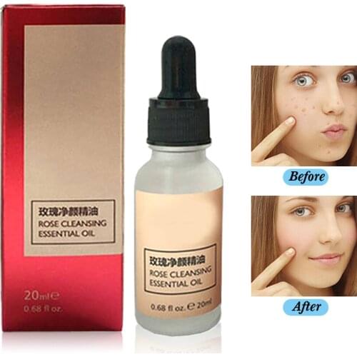Rose Essential Oil Skin Tag Removal Remove Moles And Repair Scars Painless Dark Spot Clean Face Wart Freckle Removal Cream 20ml