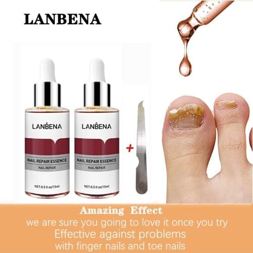 LANBEAN Nail Care Essence Fungal Nail Repair Remove Onychomycosis Toes Athletes Foot Hand And Foot Skin Care 2PCS