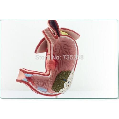 Gastric Lesions Presentation Model,Stomach Trouble Anatomical Model,Stomach Model