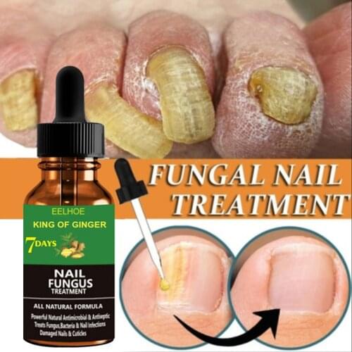 20ml Ginger Foot Antifungal Nail Essence Nails Care Repair Nail Fungal Treatment Antifungal Onychomycosis Removal Liquid